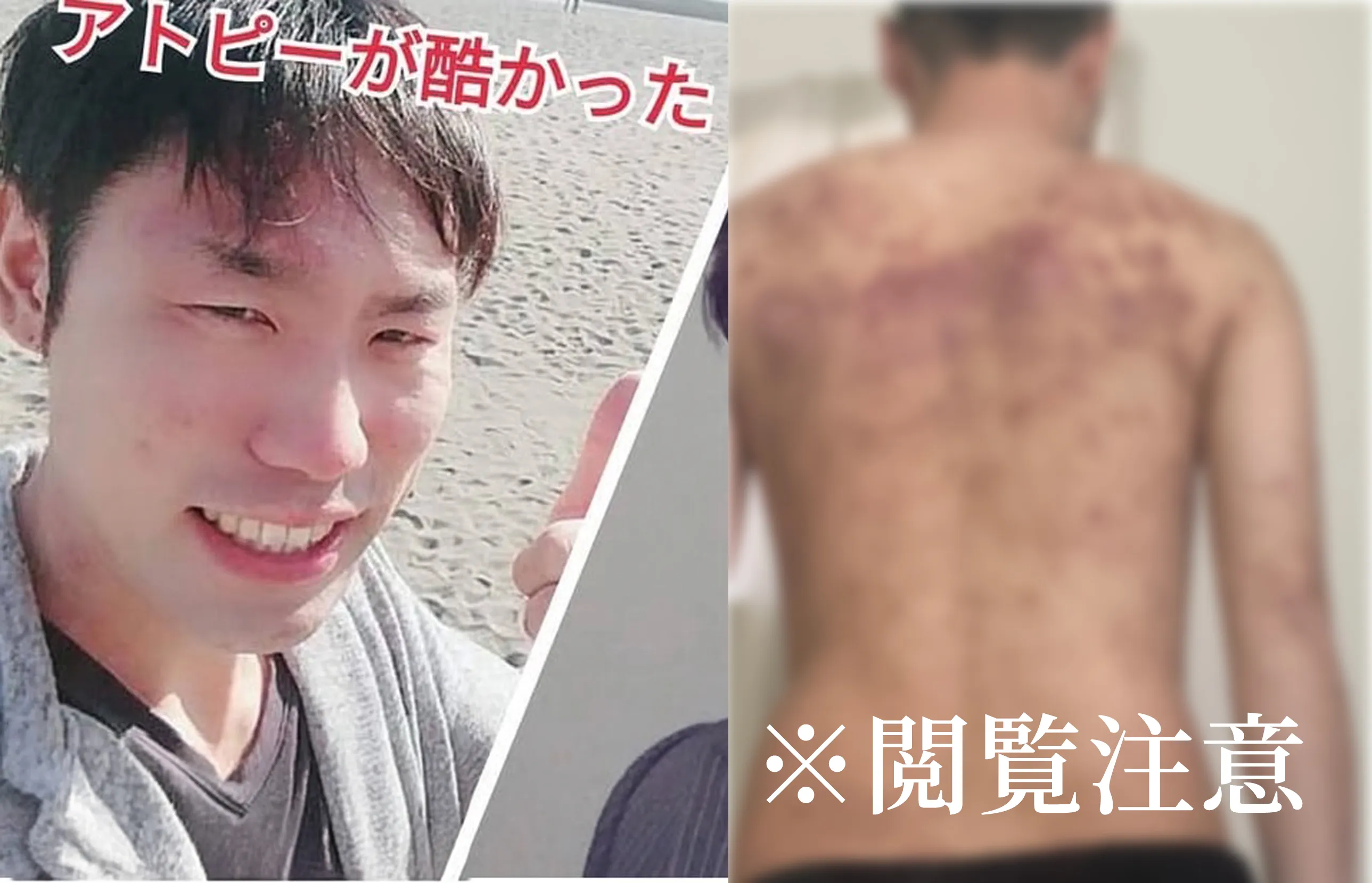 アトピーで苦しんでいた頃の写真
